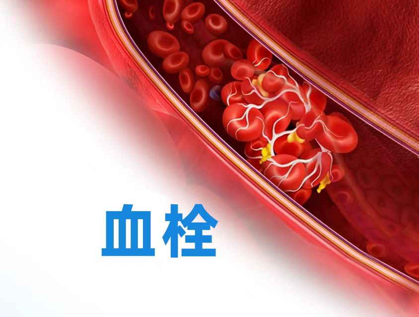 血管哨兵：探索六項(xiàng)關(guān)鍵血栓標(biāo)志物檢測(cè)！